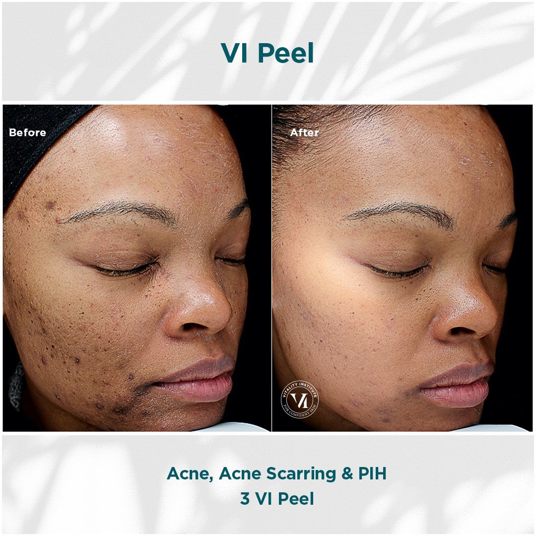 VI Peel 1