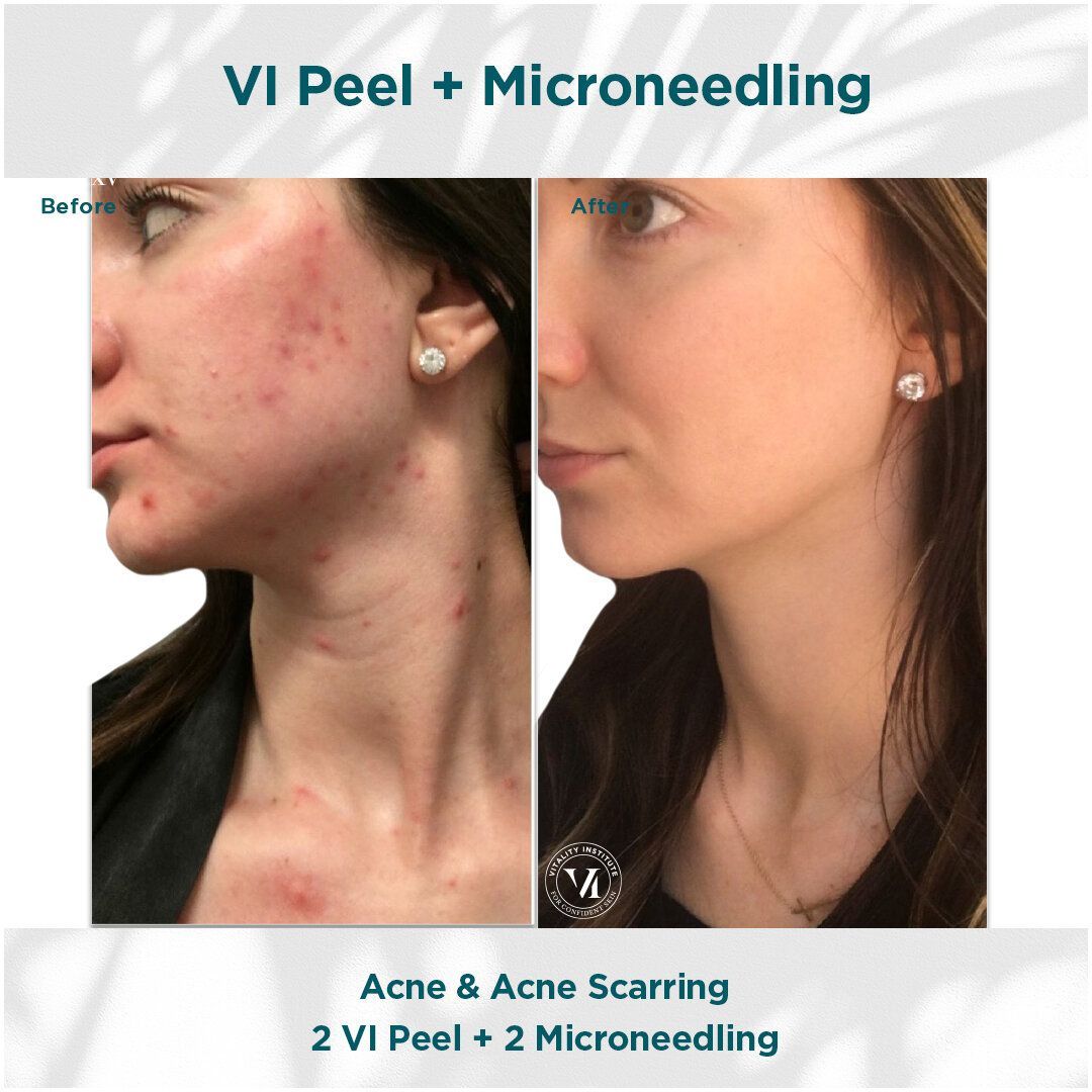 VI Peel 4