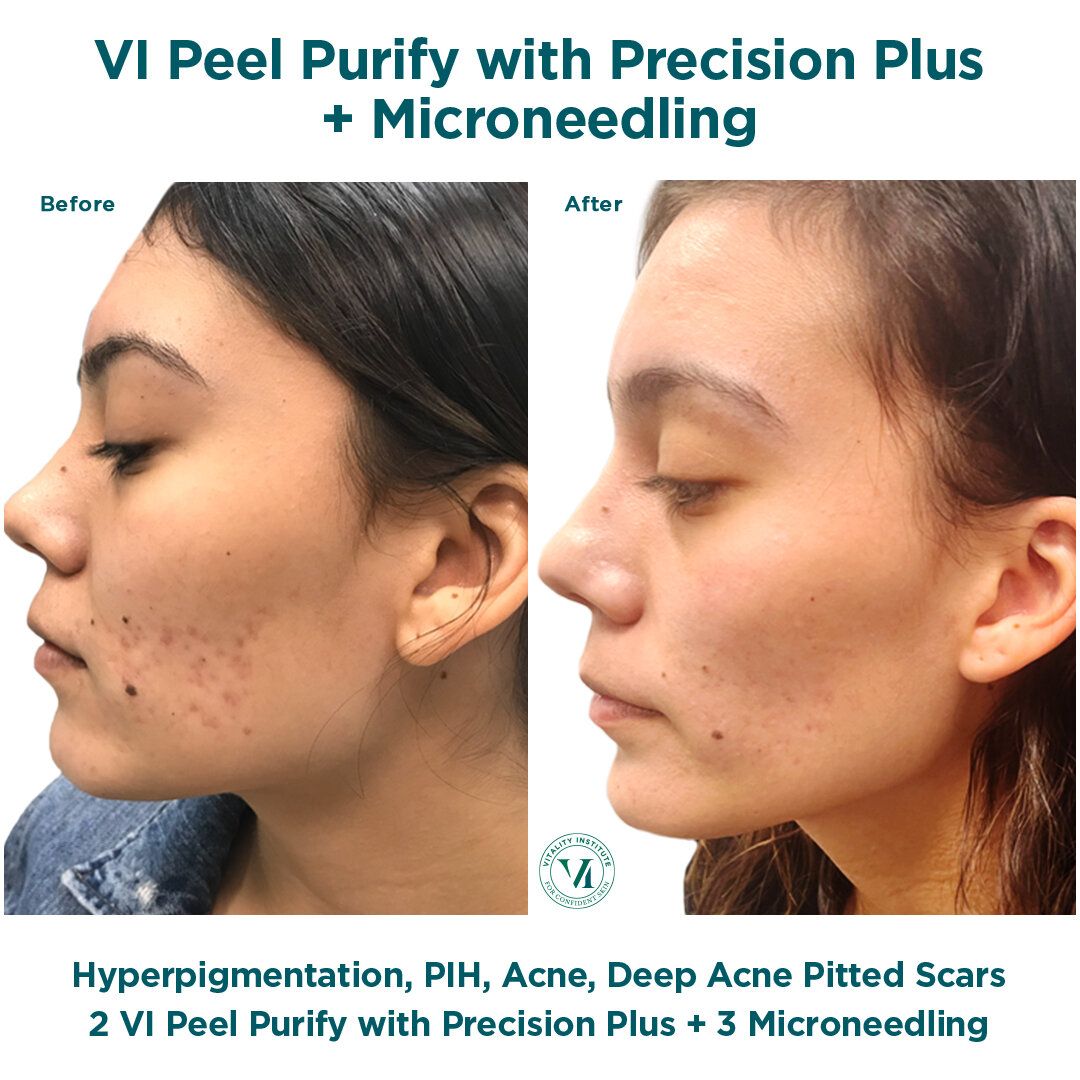 VI Peel 5