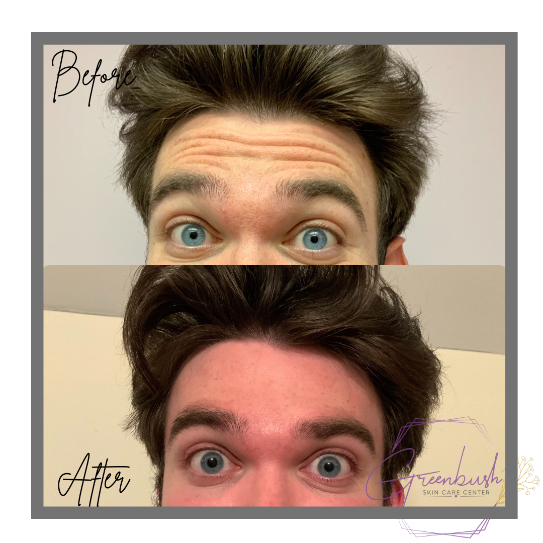 botox 1