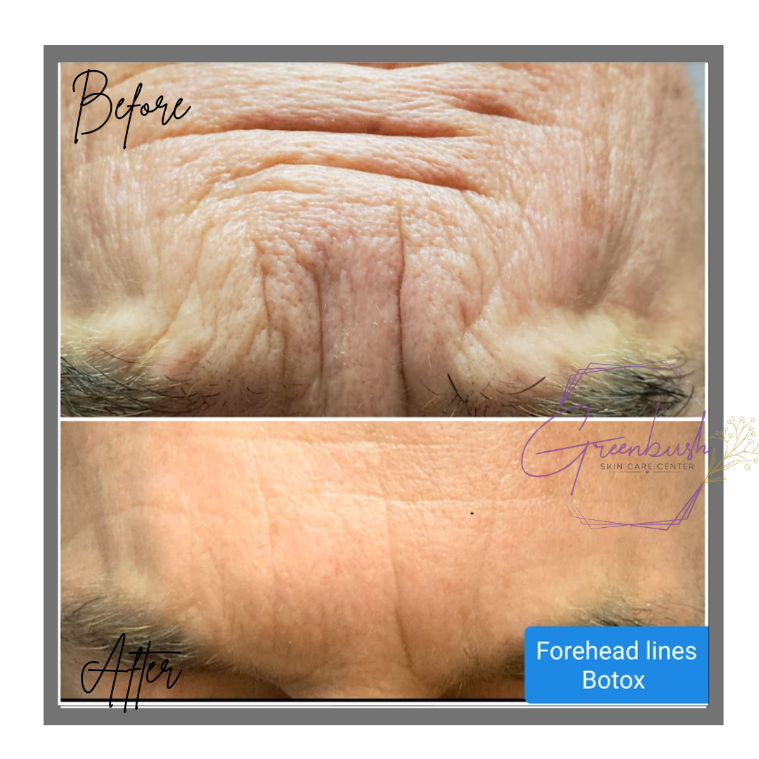 botox 2