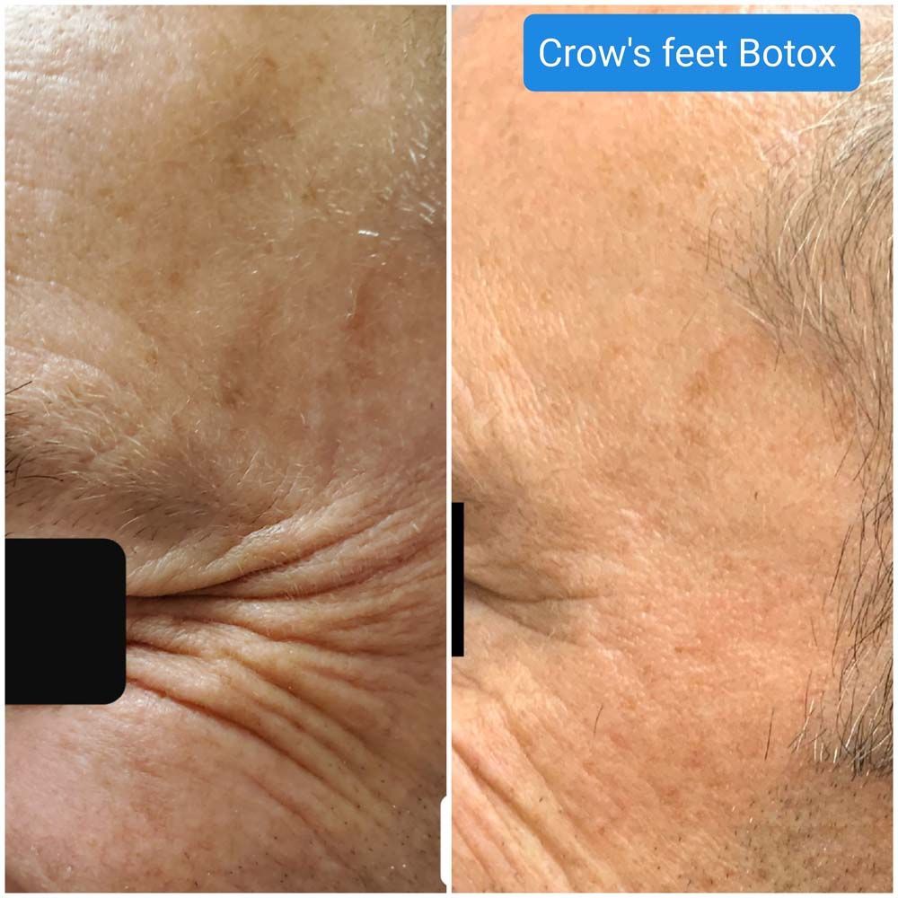 botox 4