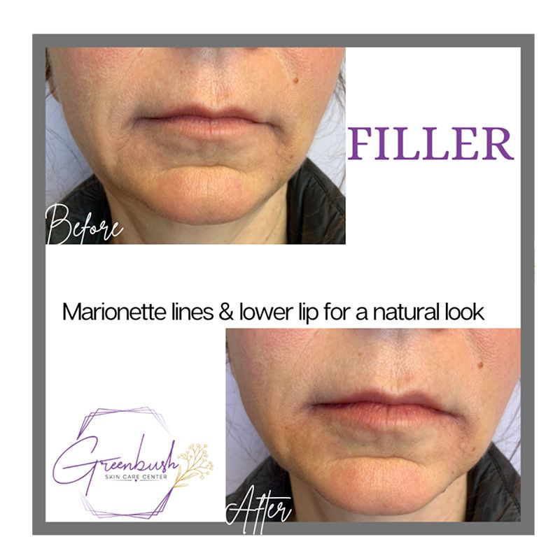 Filler 5
