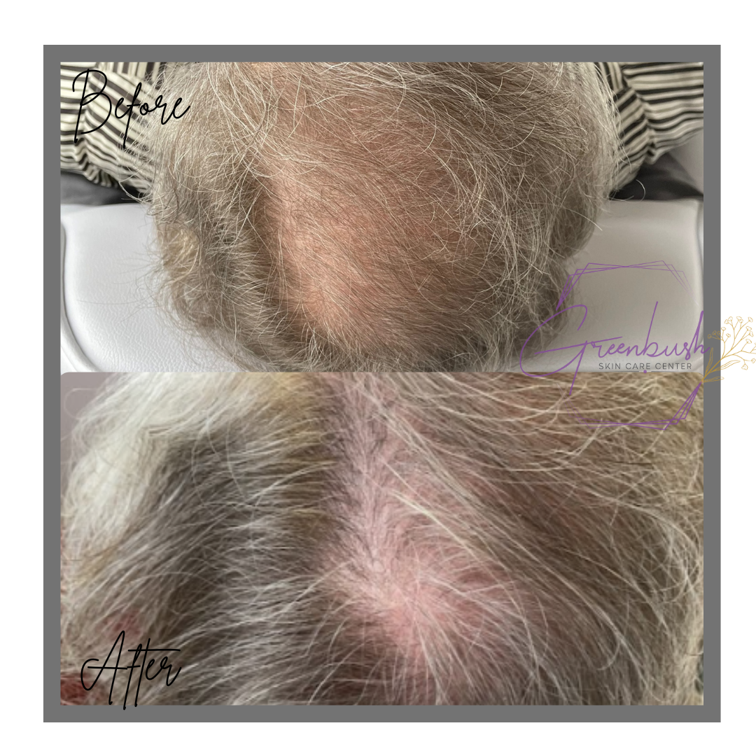 Hair Restoration 1