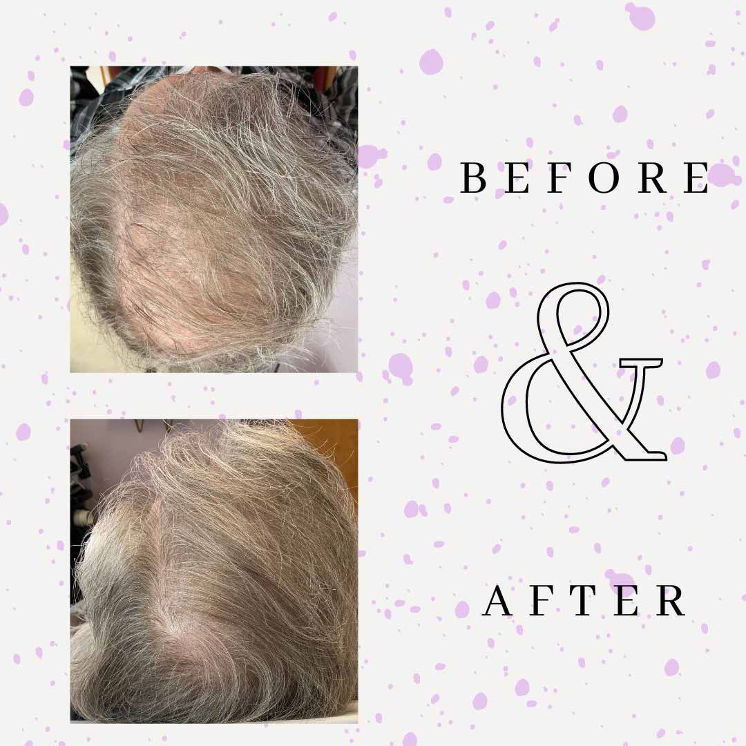 Hair Restoration 2