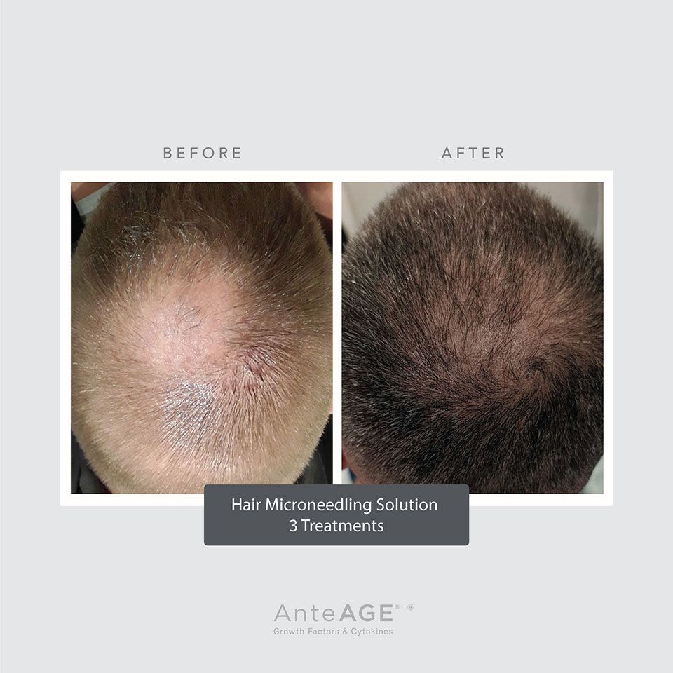Hair Rejuvenation 2