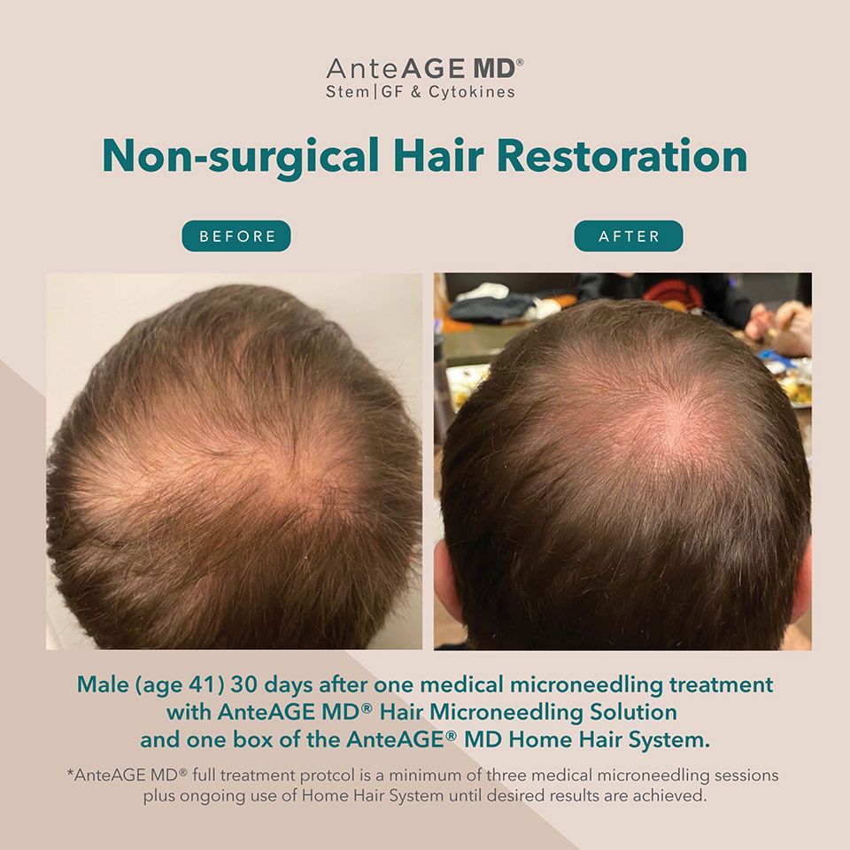 Hair Rejuvenation 3
