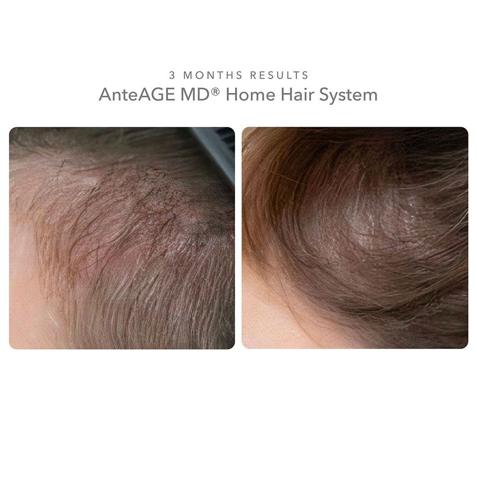 Hair Rejuvenation 5