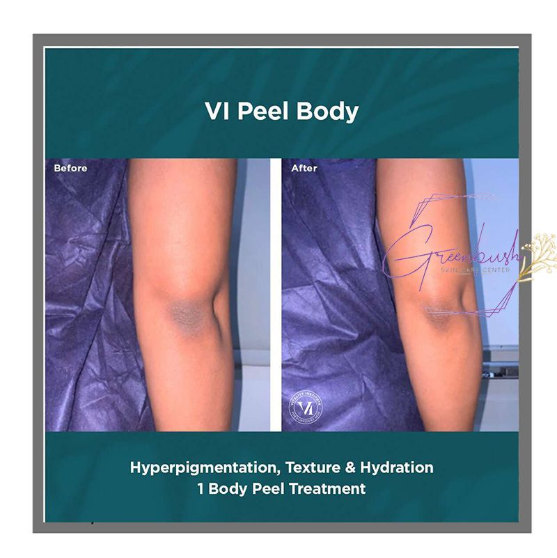 Vipeel 1
