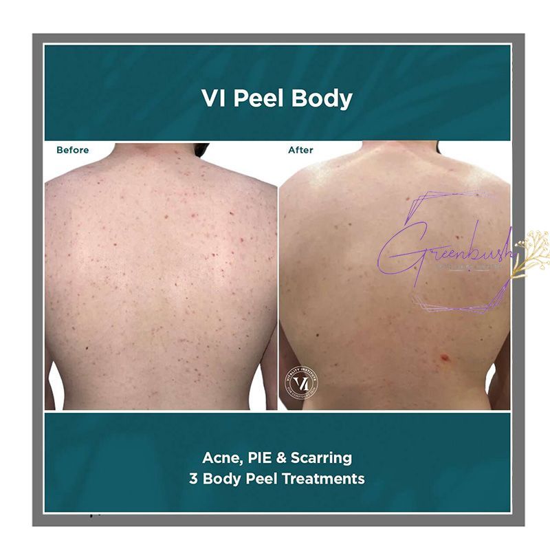 Vipeel 2