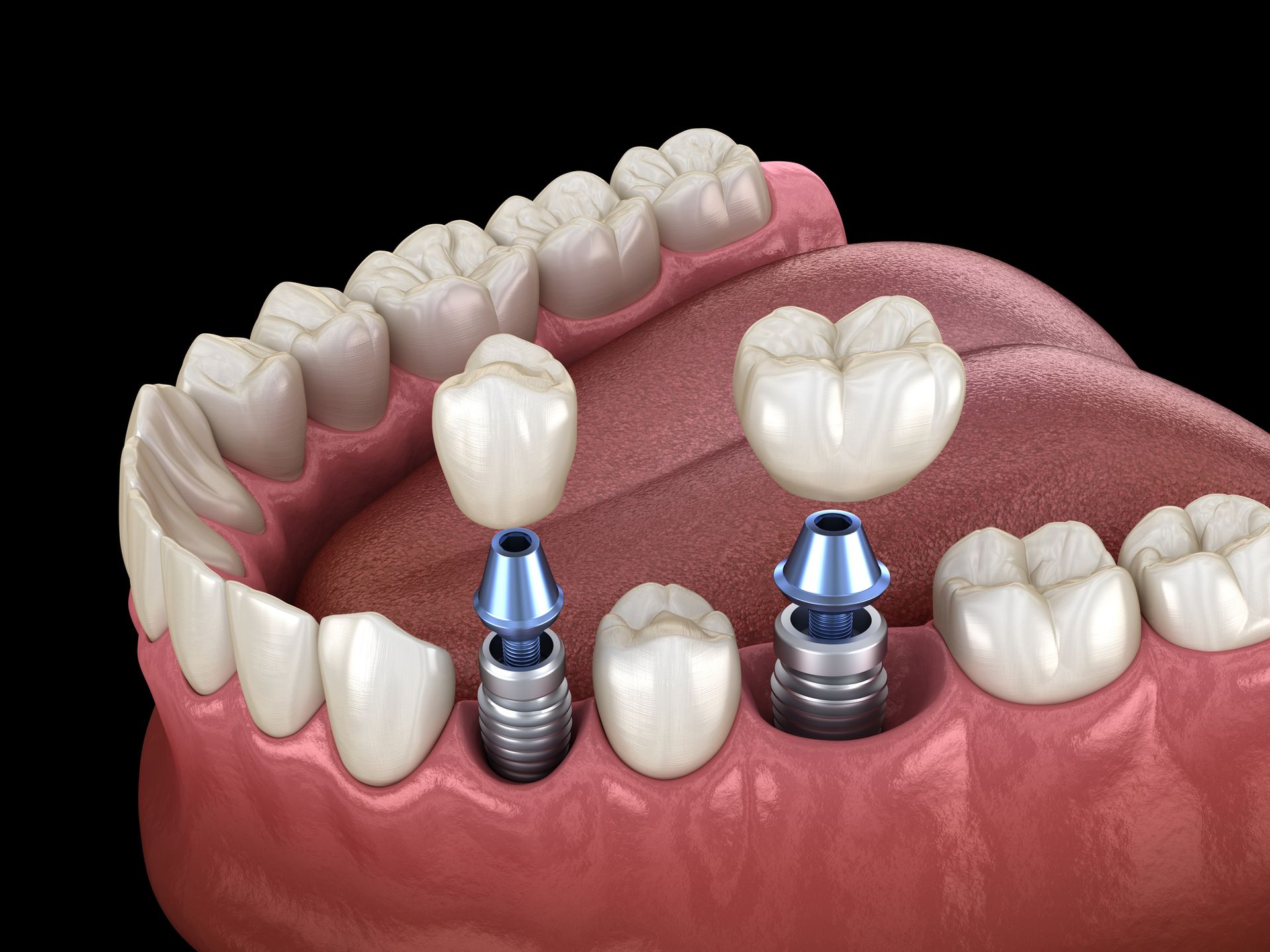 3D model of lower jaw with two dental implants supporting replacement teeth