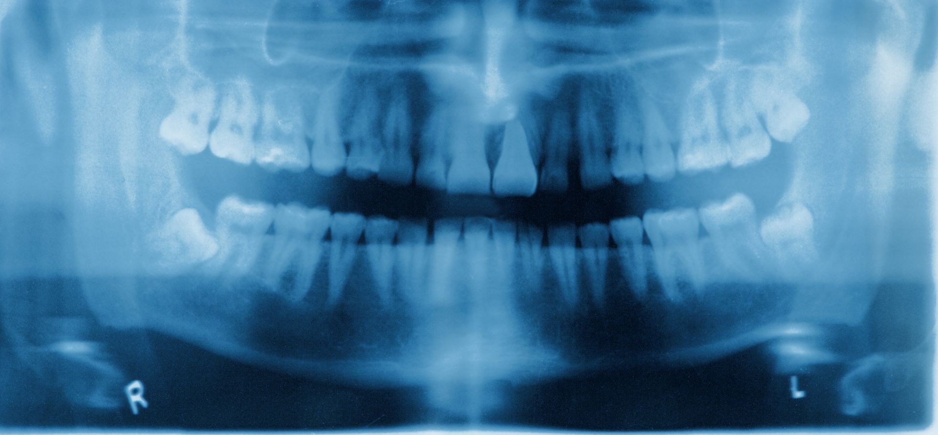 Panoramic dental X-ray of upper and lower teeth with left and right markers
