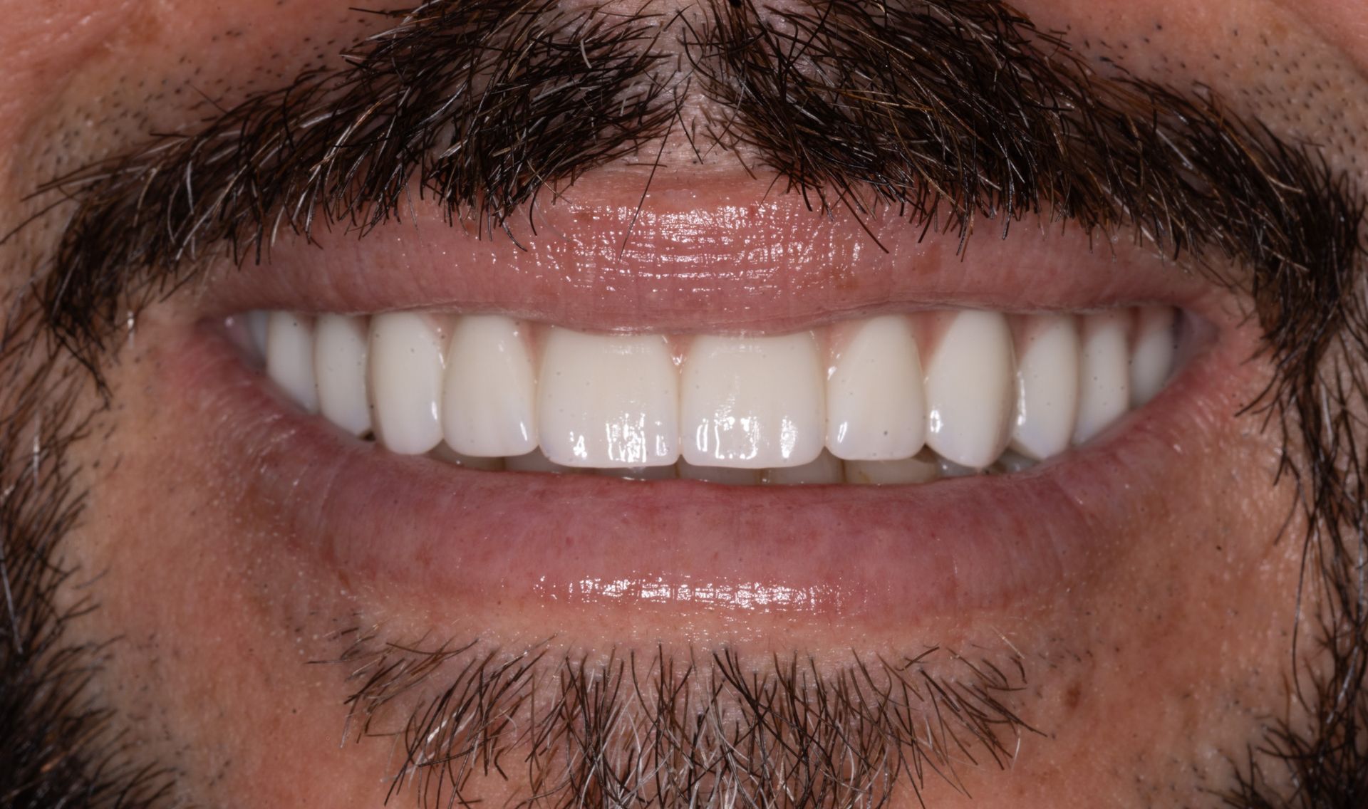 Close-up of a smiling mouth with white teeth and dark mustache and beard.