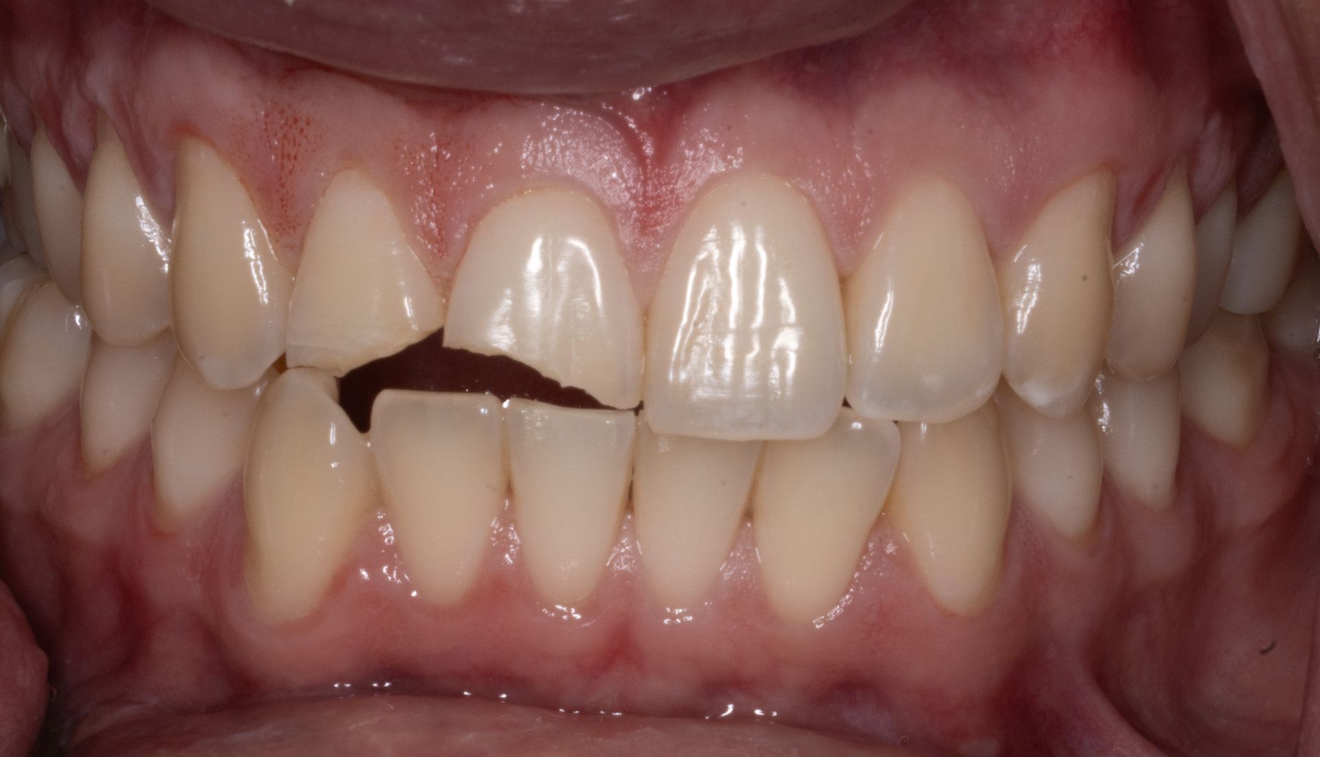 Close-up of teeth with a dark chipped gap in a front tooth and gums visible