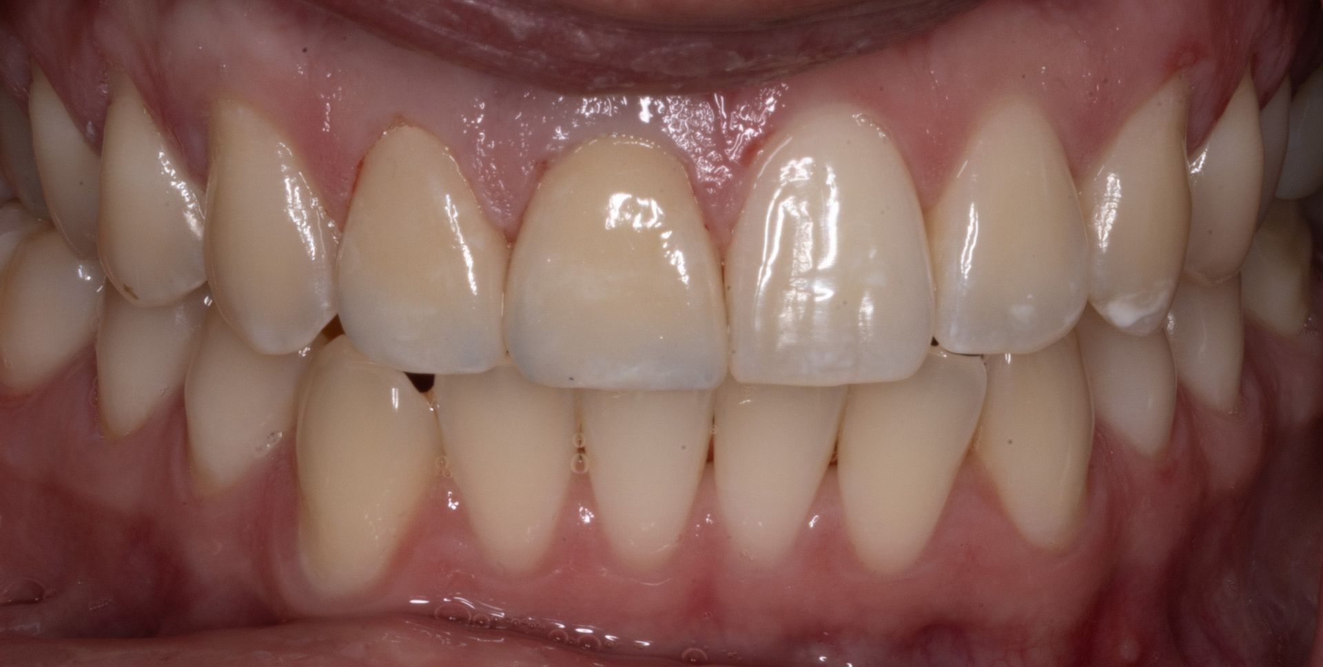 Close-up of teeth and gums with a discolored gray front tooth center