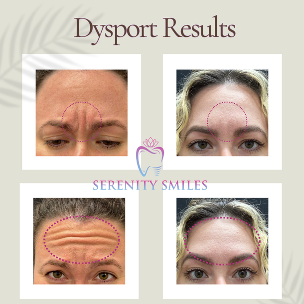 Dysport results collage showing forehead wrinkle reduction with before-and-after eyebrow and brow line images