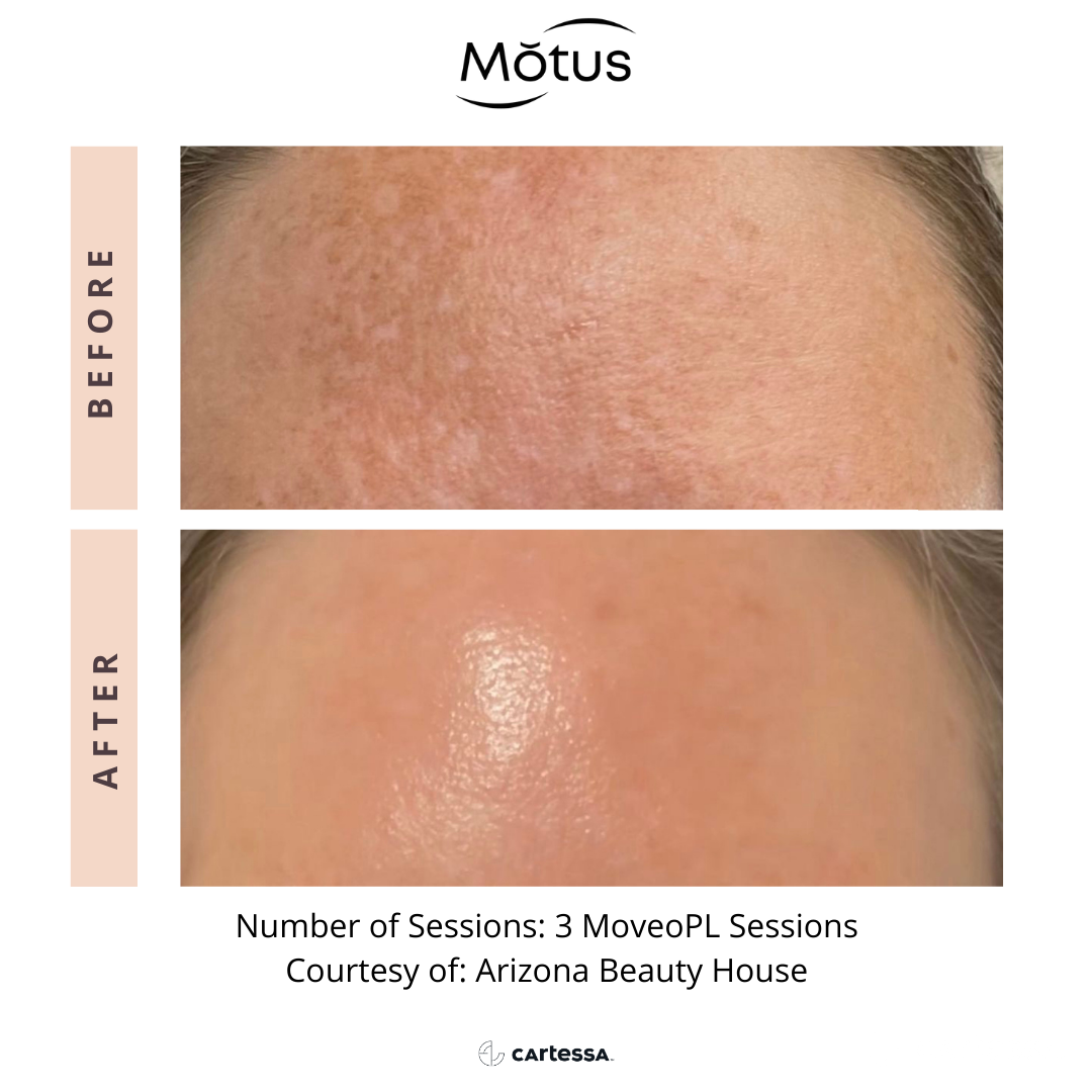 Motus PRO for sun damage before and after.