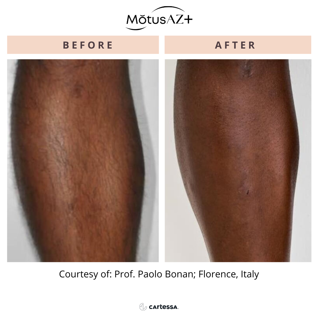Motus PRO for laser hair removal before and after.
