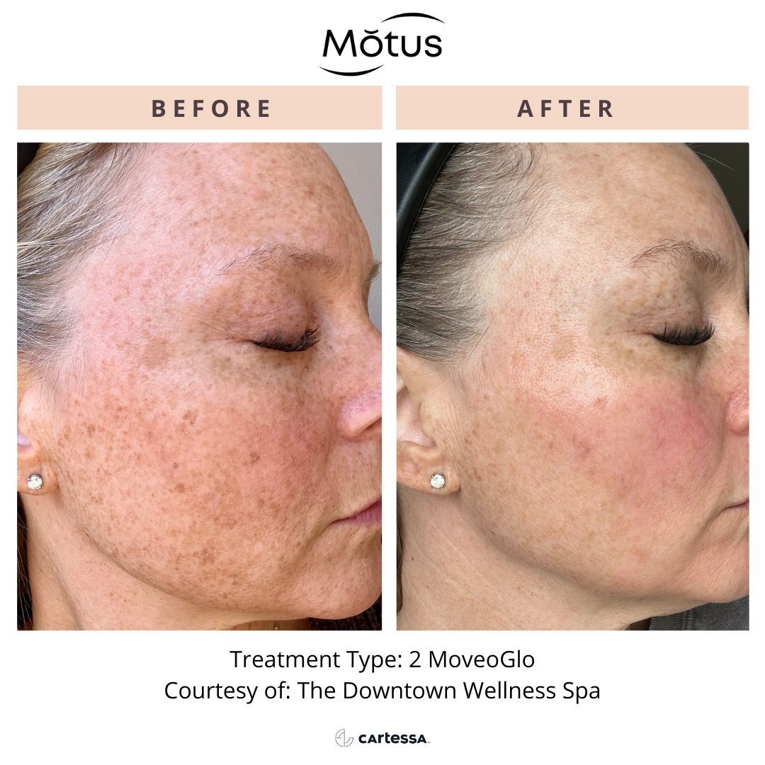 Motus PRO for sun spots before and after.