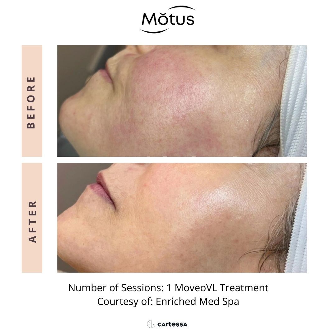 Motus PRO for redness before and after.