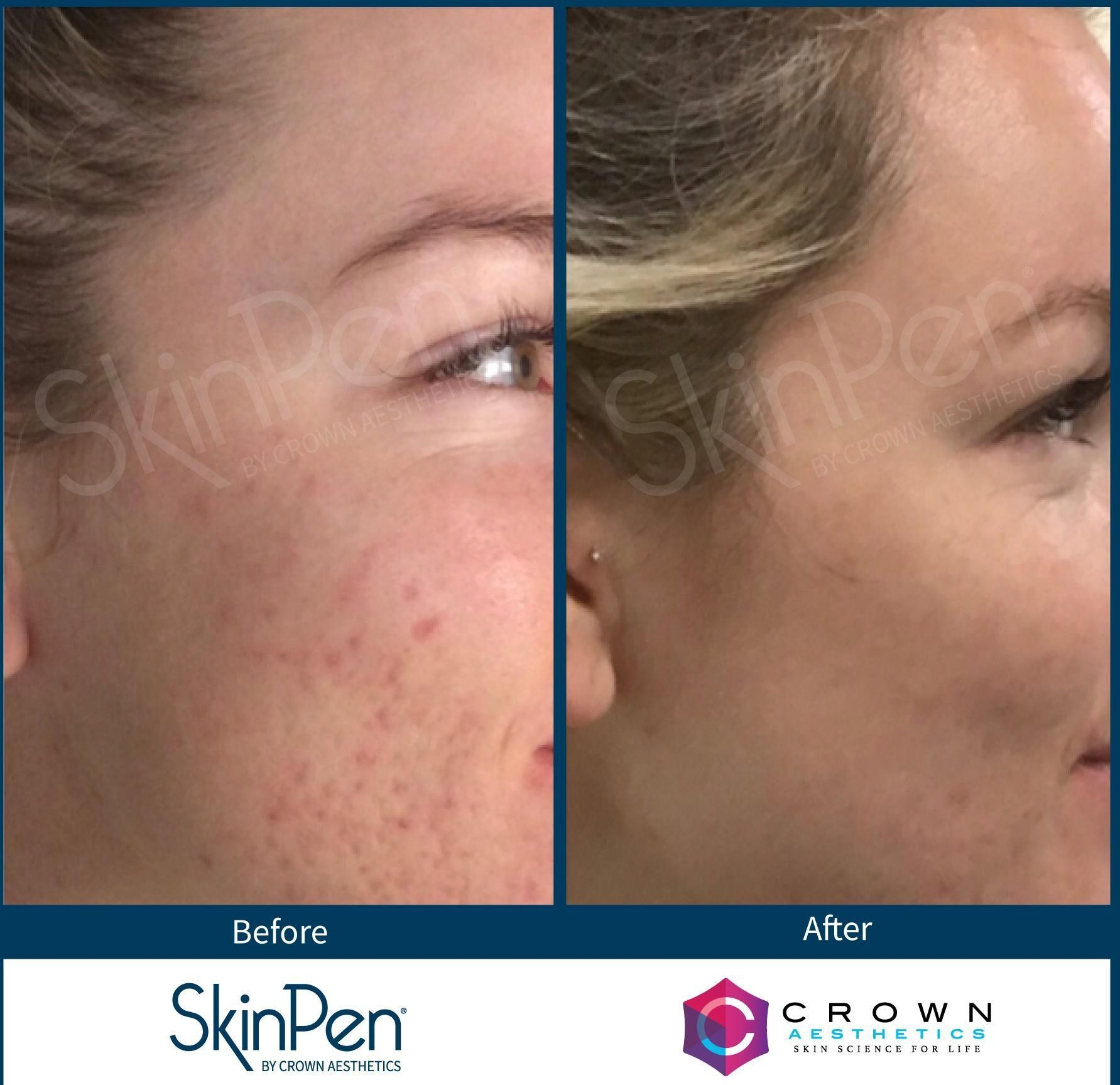 Before and after of a SkinPen Microneedling Treatment on Acne Scars
