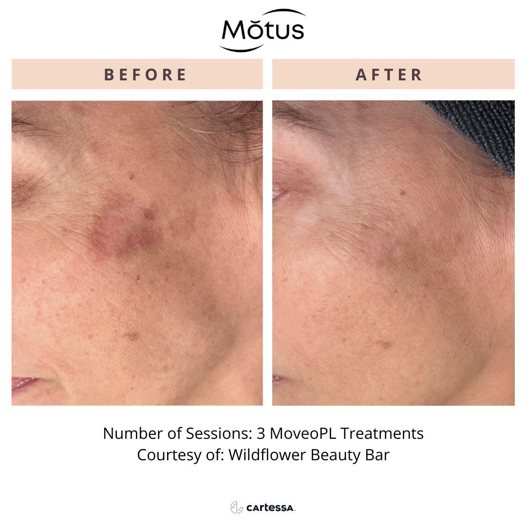 Before and after of a CoolPeel treatment on the neck