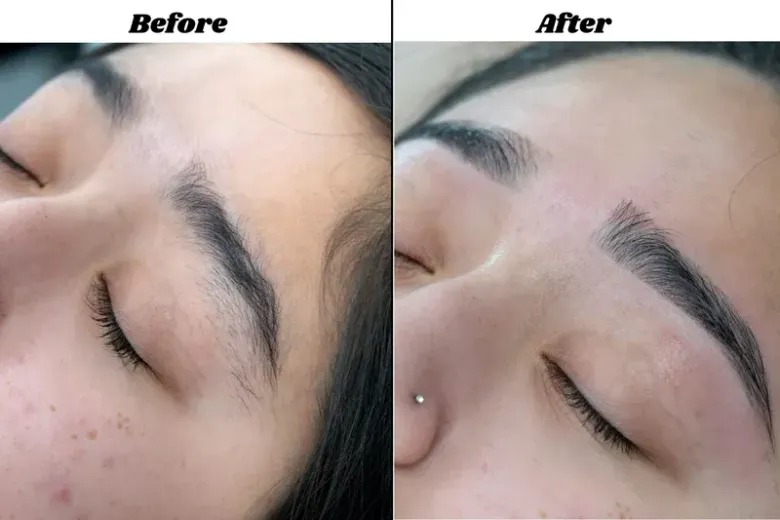 Before-and-after close-up of a closed eye with eyebrow and eyelid treatment results, labeled “Before” and “After”