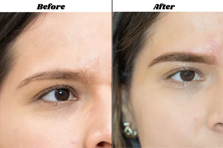 Before-and-after close-up of a woman’s eye area, showing smoother skin and reduced under-eye lines.