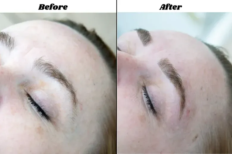 Before-and-after close-up of a eyebrow tattoo procedure on a face, showing darker, fuller brows on the right
