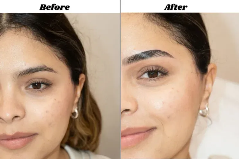 Side-by-side before and after close-up of a woman’s face with smoother, brighter skin in the after image