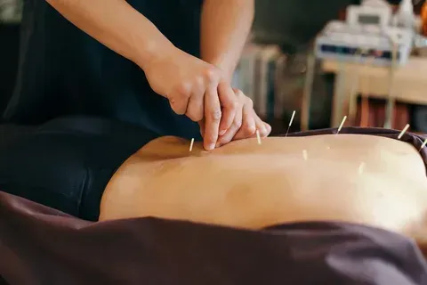 Hands placing acupuncture needles in a person's bare back during a treatment session