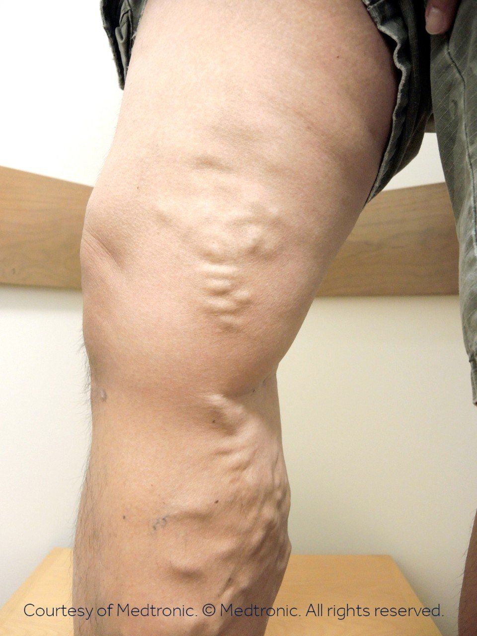 Varicose veins