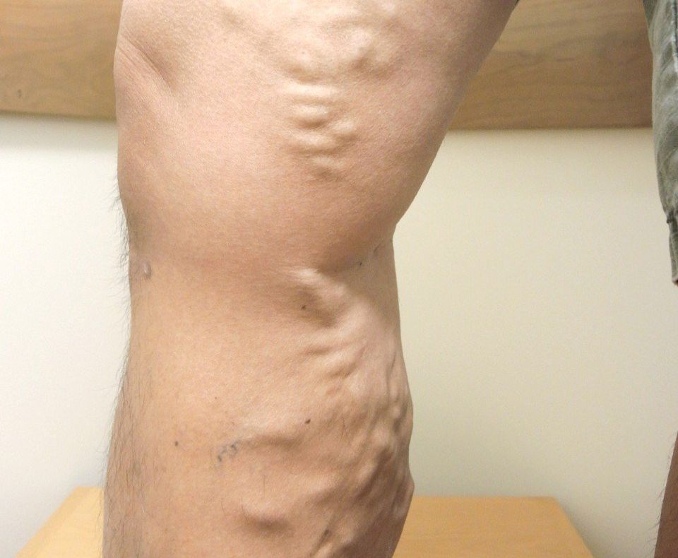 Varicose Veins
