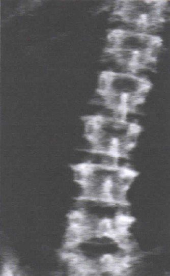 Una fotografía en blanco y negro de la columna vertebral de una persona.