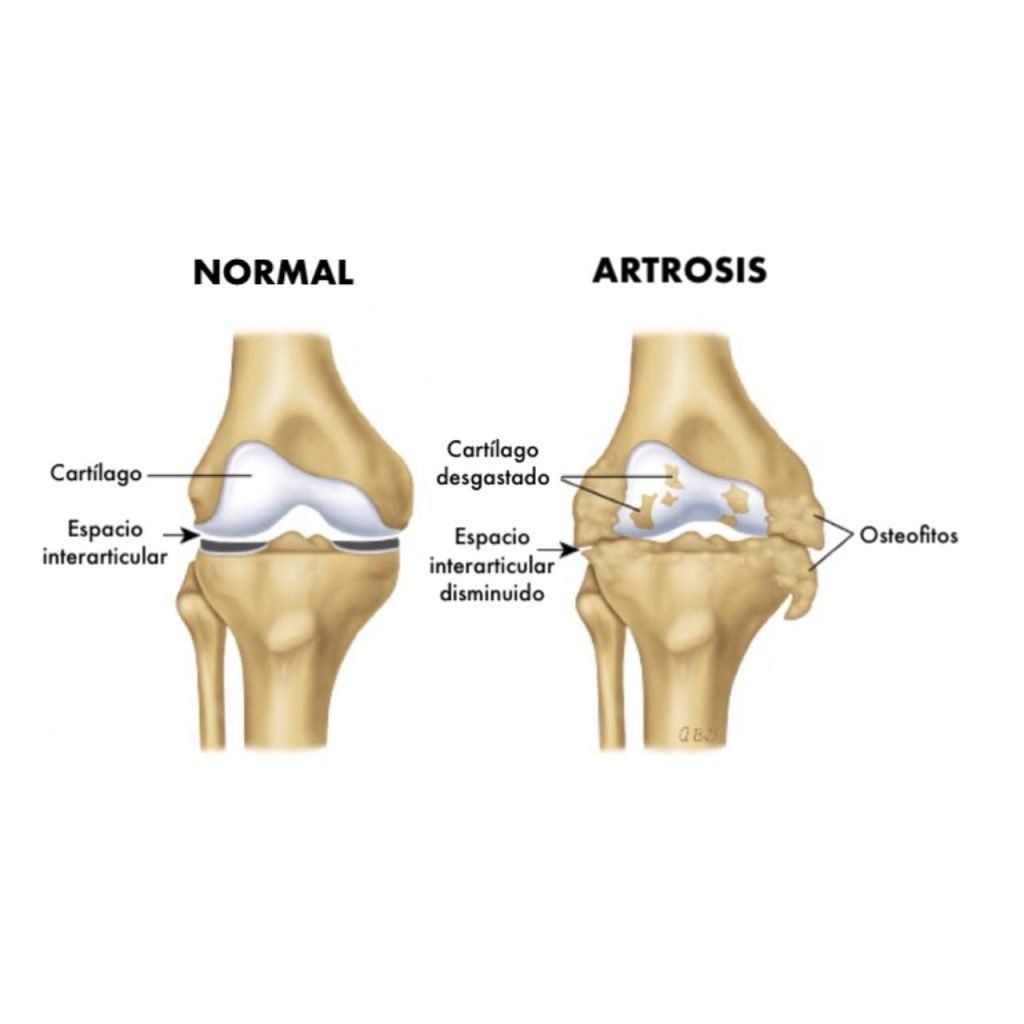 Un diagrama de una articulación de rodilla normal y una articulación de rodilla artrítica.