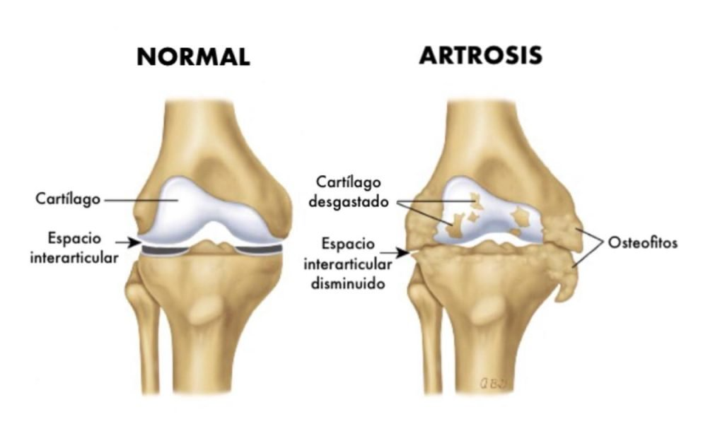 Diagrama de una rodilla normal y una rodilla artósica.
