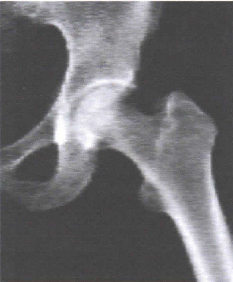 Una radiografía en blanco y negro de una articulación de la cadera.