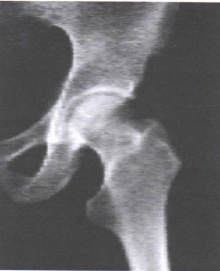 Una radiografía en blanco y negro de una articulación de la cadera.