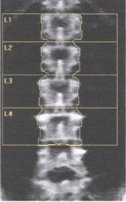 Radiografía de la columna vertebral con las letras l1 l2 l3 y l4 visibles.