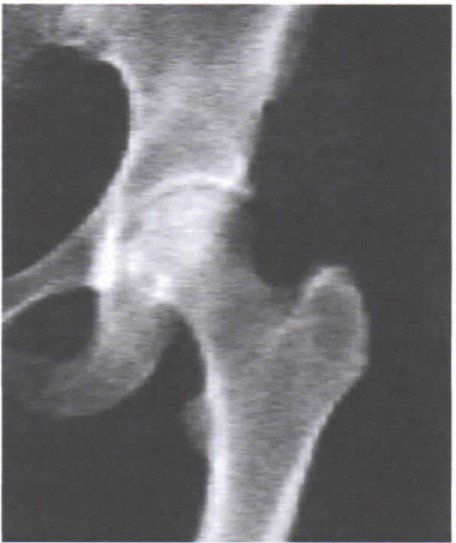 Una fotografía en blanco y negro de una articulación de la cadera.