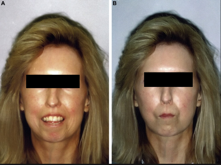 Dos fotografías de la cara de una mujer con un bloque negro en los ojos.