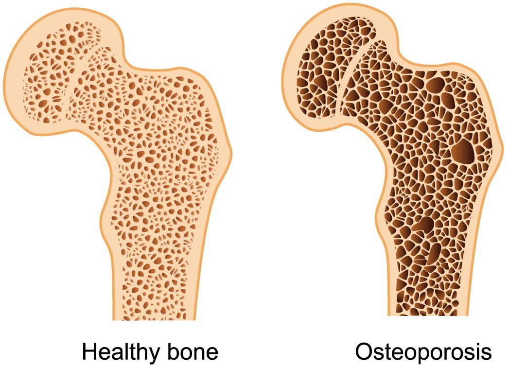 Diagrama de un hueso sano y un hueso con osteoporosis.