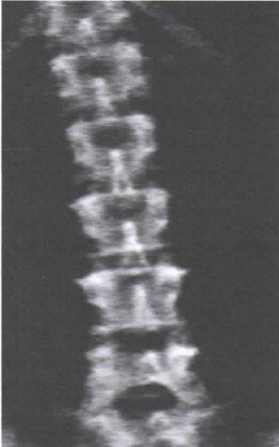 Una fotografía en blanco y negro de la columna vertebral de una persona.