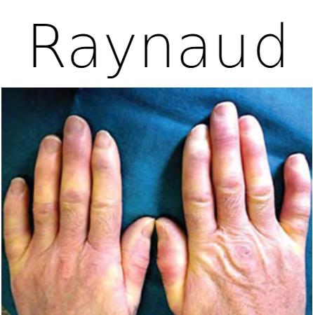 Un primer plano de las manos de una persona con la palabra Raynaud encima de ellas.