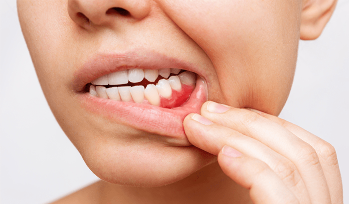 Person pulling down lower lip to show a red sore on the inner gum
