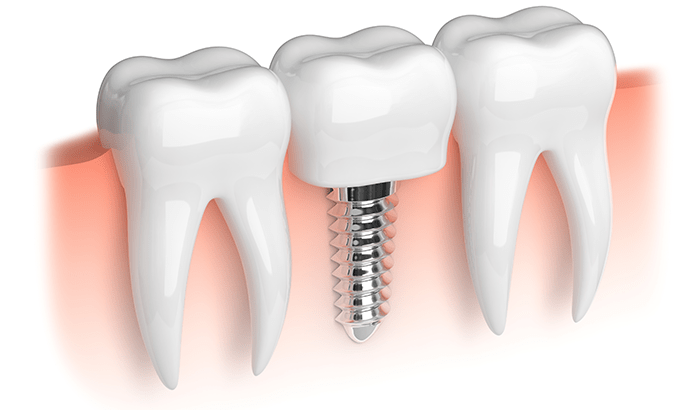 Three white molars, with a silver dental implant replacing one tooth against pink gums