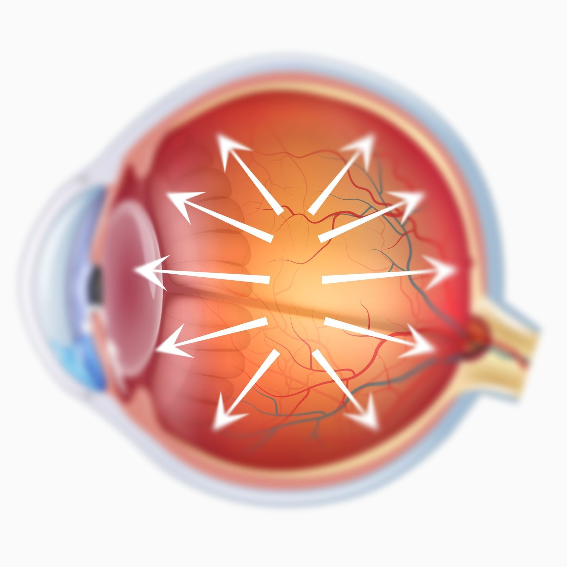 Diagram of an eye with arrows emanating from the center, illustrating intraocular pressure.