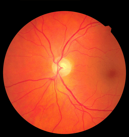 Healthy Retina