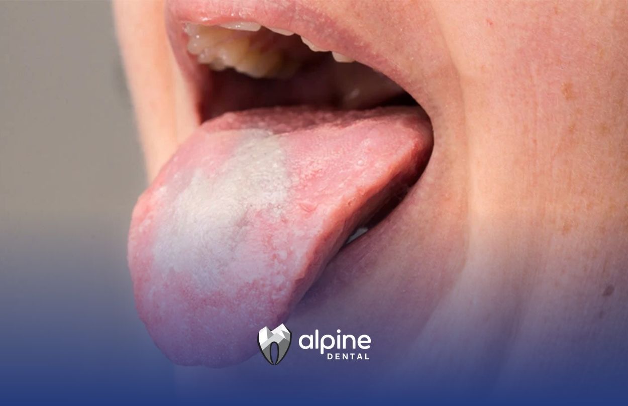 Oral candidiasis, also known as thrush, is a fungal infection of the mouth  caused by the overgrowth of Candida albicans, a type of yeast that is  normally present in small amounts in the mouth. It is a ..., image size:1250x808
