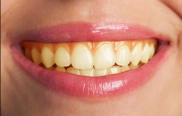 Close-up of a smiling mouth, showing yellow teeth and glossy pink lips.